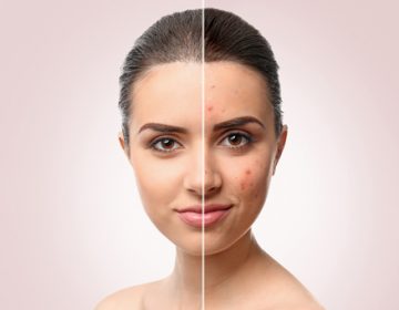5 NEW WAYS TO TREAT NEW AND OLD ACNE SCARS - Woman's face before and after treatment