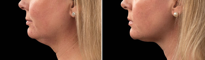 Woman's face, Before and After CoolSculpting Treatment, left side view, patient 12