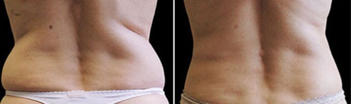 Woman's body, Before and After CoolSculpting Treatment, back view, patient 4