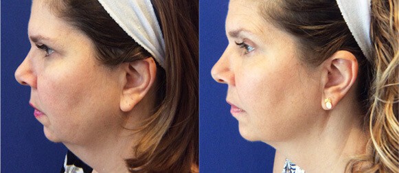 Woman's face, Before and After BTL EXILIS Treatment, female patient, left side view