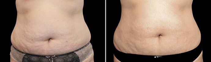 Woman's body, Before and After EXILIS ULTRA Treatment, stomach, front view, female patient 1