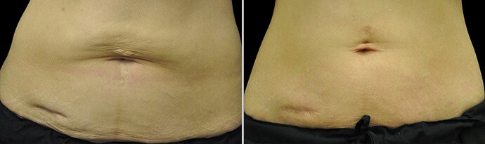 Woman's body, Before and After EXILIS ULTRA Treatment, stomach, front view, female patient 4