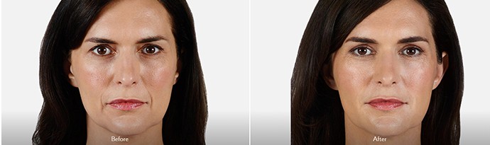 Woman's face, Before and After DERMAL FILLERS Treatment, front view, female patient 6