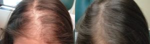 Before and After PRP TREATMENT FOR HAIR LOSS, female head, patient 1