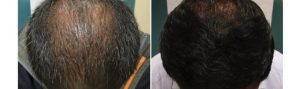 Before and After PRP TREATMENT FOR HAIR LOSS, front view, male head, patient 10