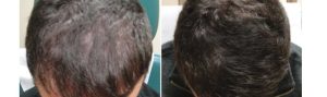 Before and After PRP TREATMENT FOR HAIR LOSS, front view, male head, patient 11