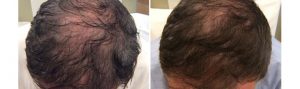 Before and After PRP TREATMENT FOR HAIR LOSS, male head, patient 2