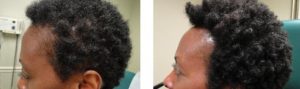 Before and After PRP TREATMENT FOR HAIR LOSS, left side view, male head, patient 3