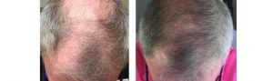 Before and After PRP TREATMENT FOR HAIR LOSS, front view, male head, patient 4