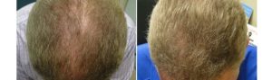 Before and After PRP TREATMENT FOR HAIR LOSS, front view, male head, patient 5