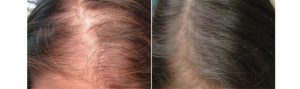 Before and After PRP TREATMENT FOR HAIR LOSS, female head, patient 6