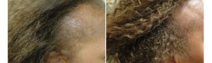 Before and After PRP TREATMENT FOR HAIR LOSS,right side view, female head, patient 7