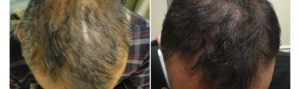 Before and After PRP TREATMENT FOR HAIR LOSS, front view, male head, patient 8