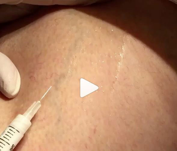 Watch Instagram Video: When the weather turns it's a perfect time to treat those pesky #legveins with #sclerotherapy.