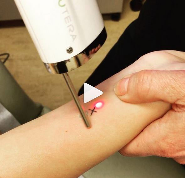 Watch Instagram Video: Excited to be the first in #philly to offer the new #cuteraenlighten laser to painlessly zap away ink in half the time