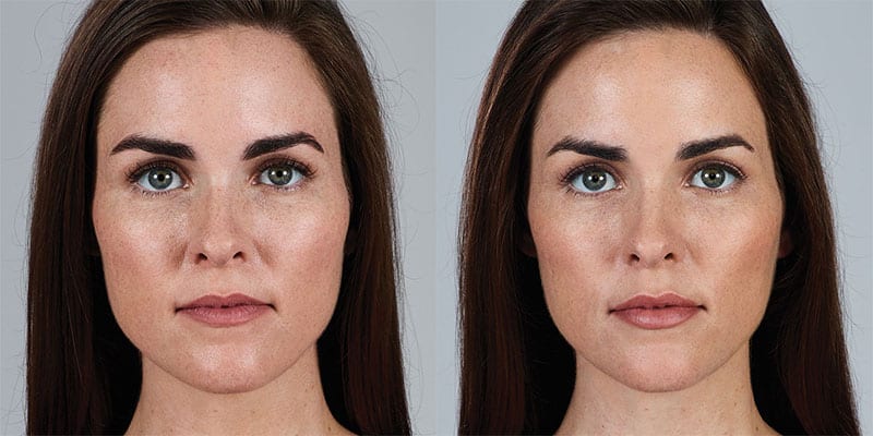 juvederm cheeks before and after photos