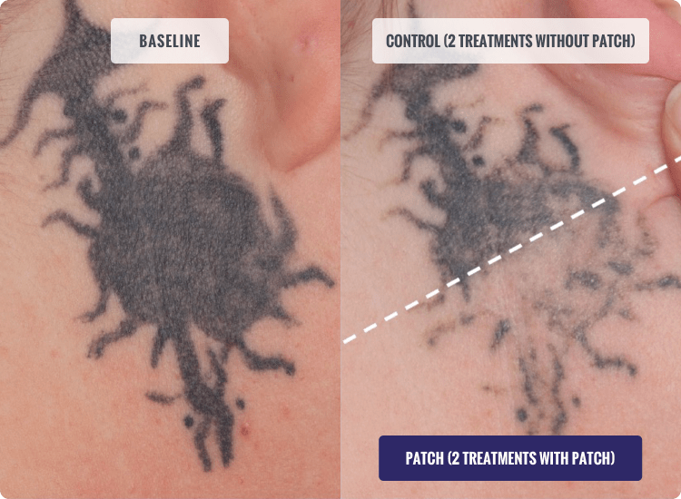 Before and After TATTOO REMOVAL Treatment, patient 2