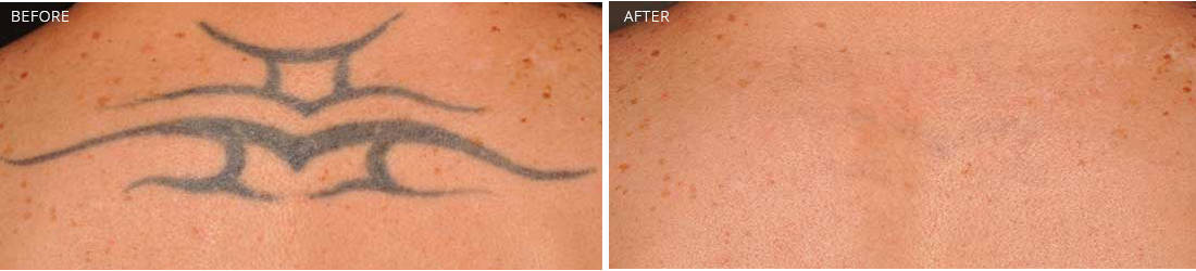 Before and After TATTOO REMOVAL Treatment