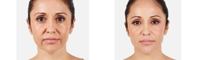 Woman's face, Before and After vollure Treatment, front view, female patient 4