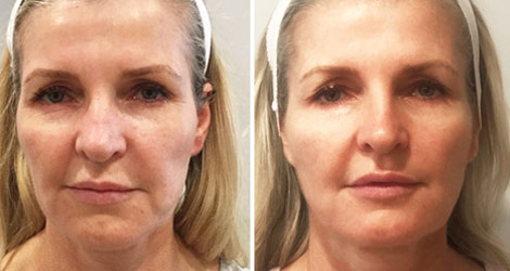 Woman's face, Before and After Silhouette InstaLift Treatment, right side oblique view, female patient 2