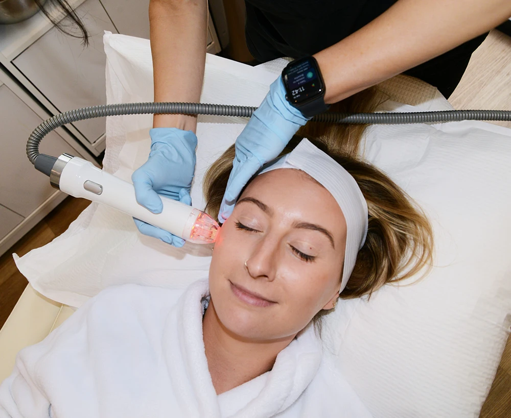 Photo: patient at treatment with Vivace Microneedling