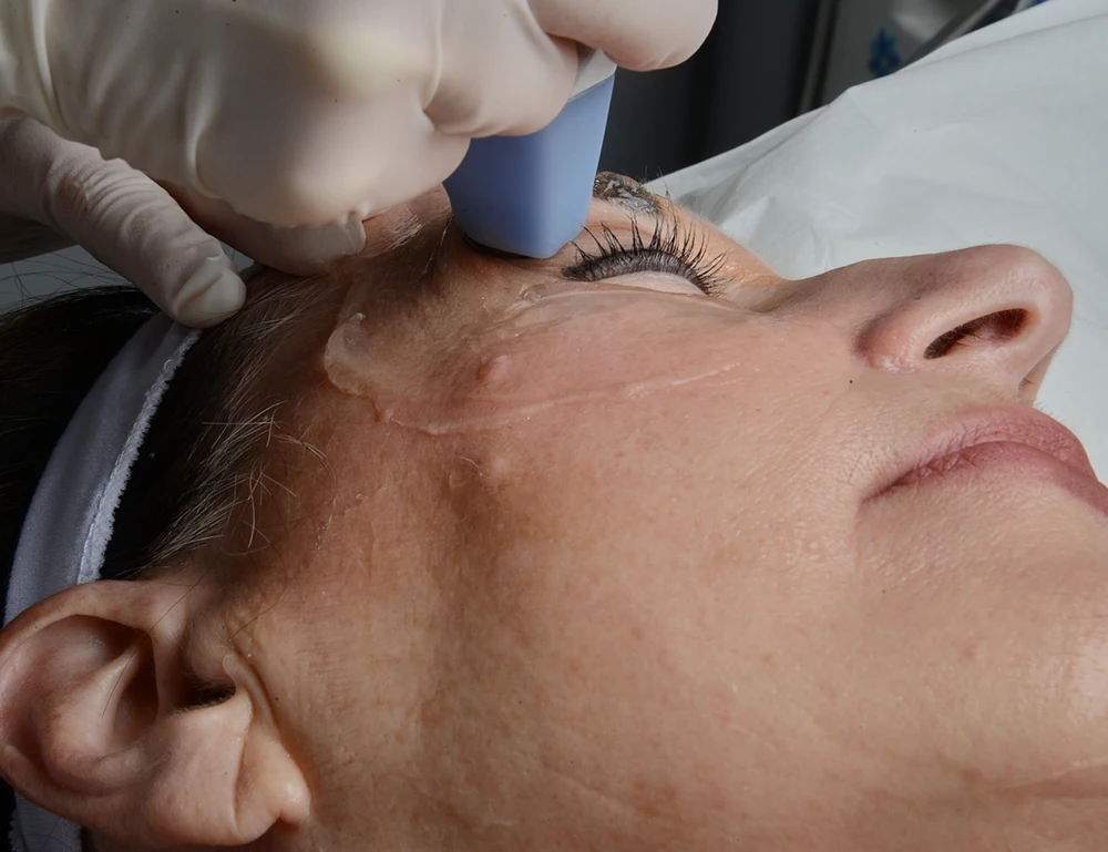 Female patient at Droopy Eyebrow treatment (patient 1)