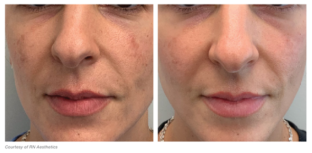 Woman's face, before and after MOXI Laser Treatments, front view - patient 1