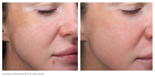Woman's face, before and after MOXI Laser Treatments, oblique view - patient 2