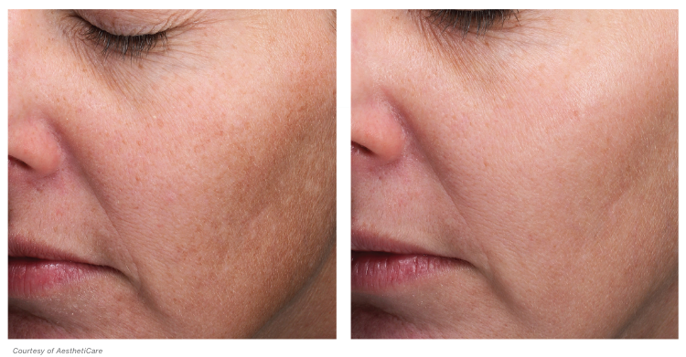 Woman's face, before and after MOXI Laser Treatments, l-side oblique view - patient 2