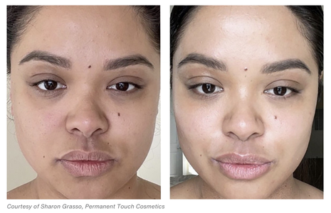Woman's face, before and after MOXI Laser Treatments, front view - patient 5