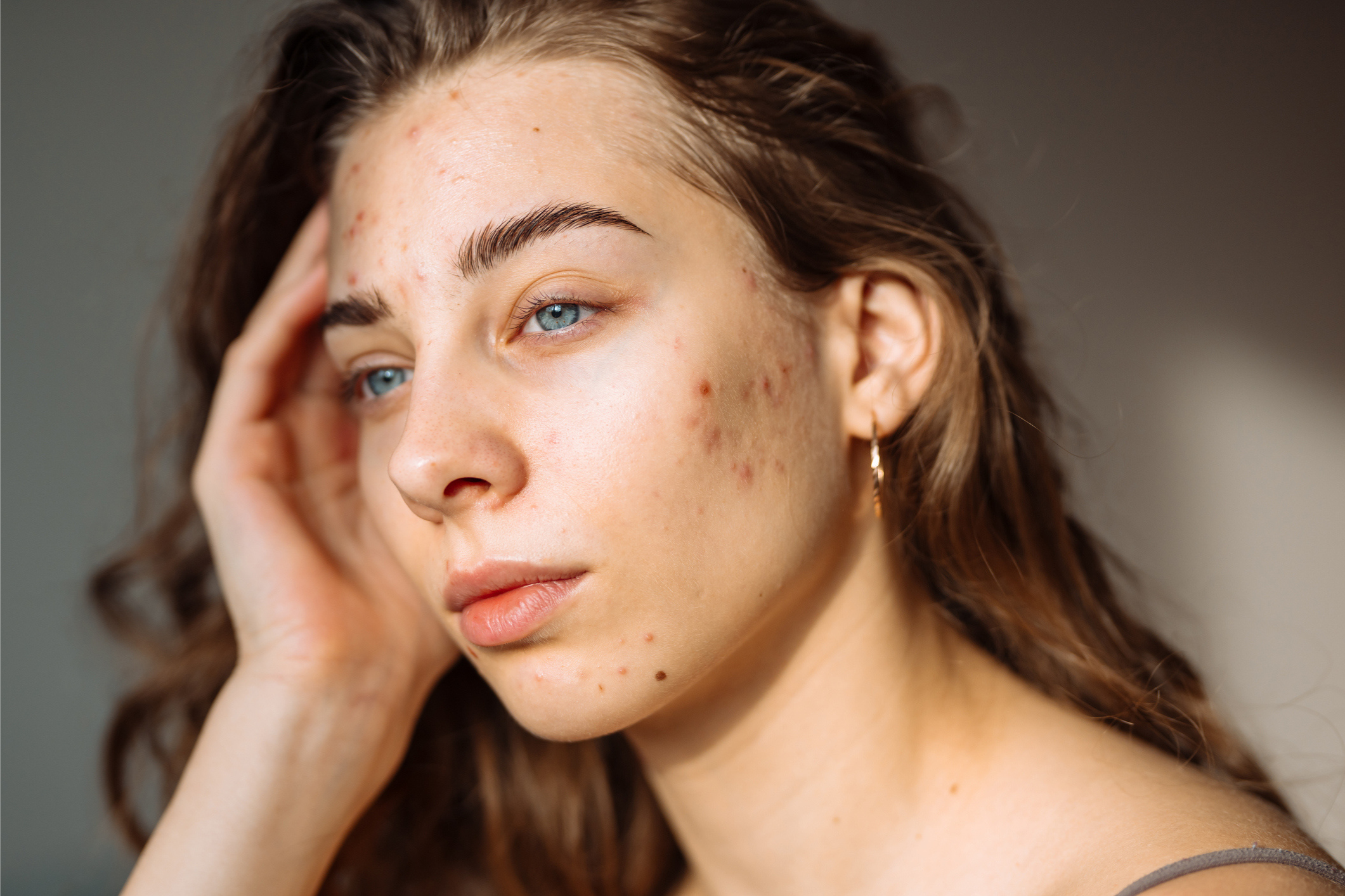  Acne Scar Treatment in Philadelphia & Montgomery County Banner
